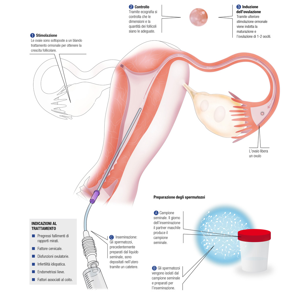 inseminazione-intrauterina-5